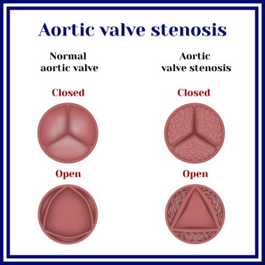 Aortic valve stenosis. clipart