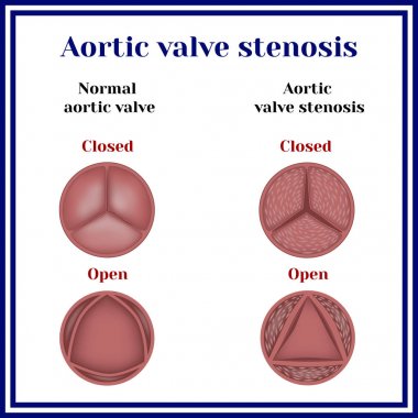 Aortic valve stenosis. clipart