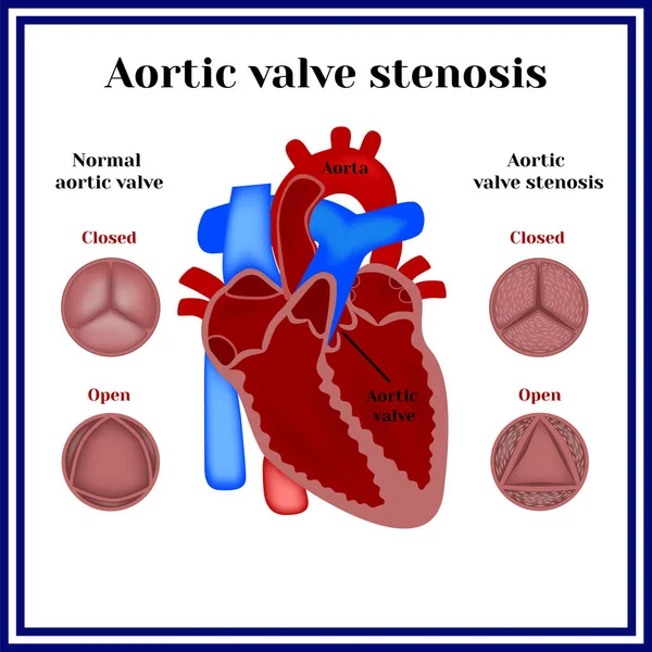 Stenosi della valvola aortica . — Vettoriale Stock