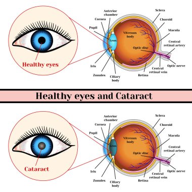 Healthy eyes and cataract (opacity of the eye lens).   clipart