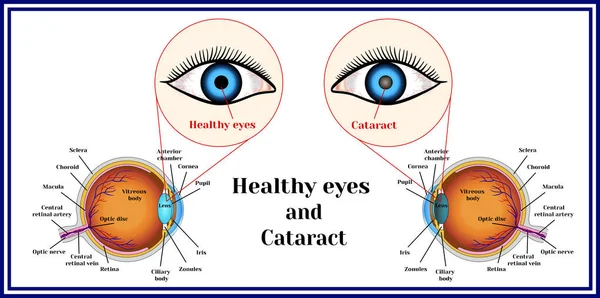 Gezonde ogen en cataract (dekking van de lens van het oog). — Stockvector