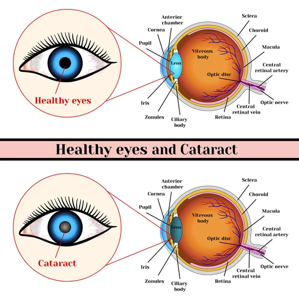 Ojos sanos y cataratas (opacidad de la lente ocular ). — Archivo Imágenes Vectoriales