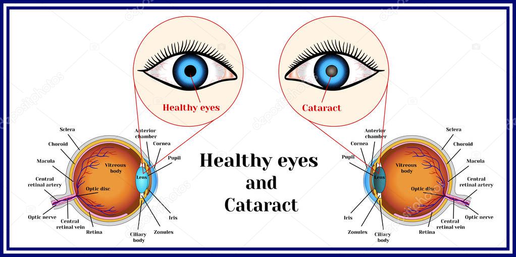 Healthy eyes and cataract (opacity of the eye lens).  