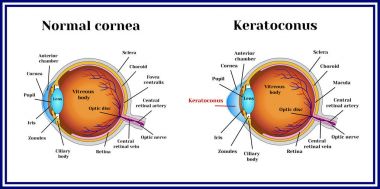 Keratoconus. Dystrophic disease of the cornea. clipart