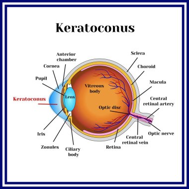 Keratoconus. Dystrophic disease of the cornea. clipart