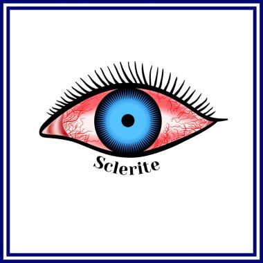 Sclerite. Inflammatory disease of sclera. clipart