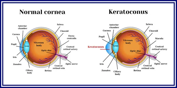 Keratoconus. Dystrophic disease of the cornea. — Stock Vector