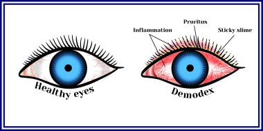 Demodex. Parasitic eye disease. clipart