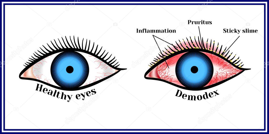Demodex. Parasitic eye disease.