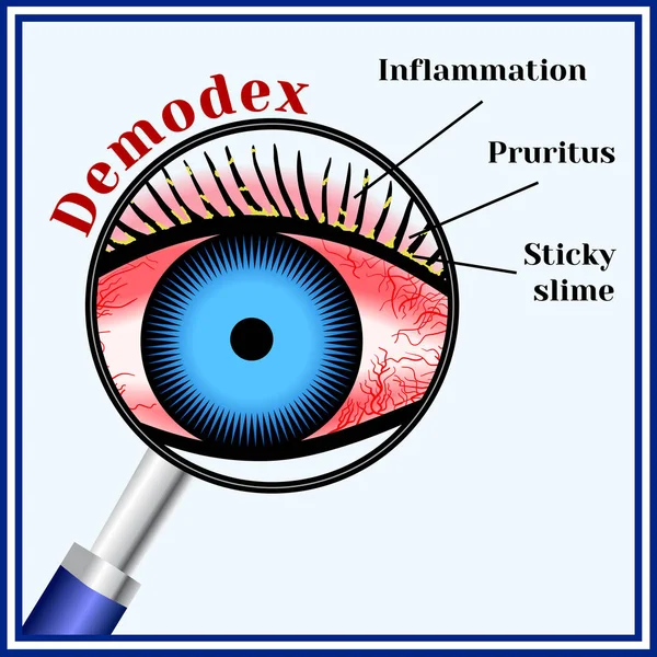 Demodex. Malattia oculare parassitaria . — Vettoriale Stock