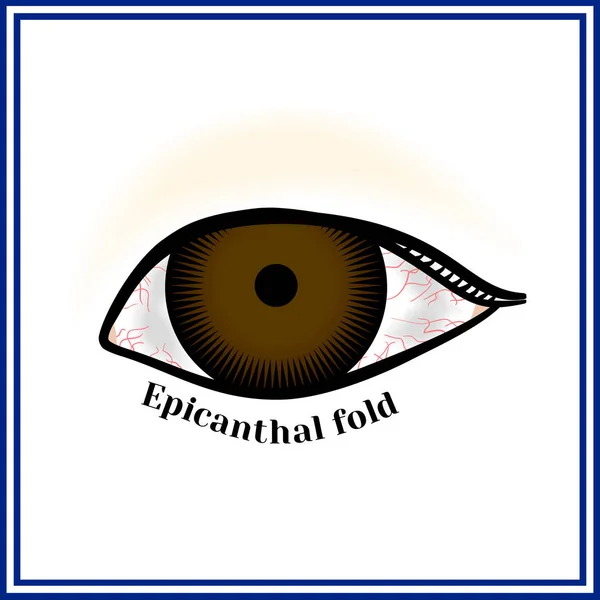 Pliegue epicantal (pliegue palpebronasal). Pliegue epicantal. Doble en la esquina interna del ojo . — Vector de stock