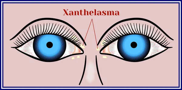 Xanthelasma입니다. 병합 된 양성 신 생물. — 스톡 벡터