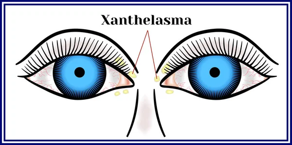 Xanthelasma. Neoplasia benigna aplanada — Vector de stock