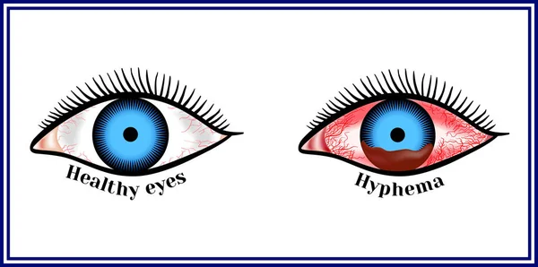 Hyphema - hemorrhage in the anterior chamber of the eye. — Stock Vector