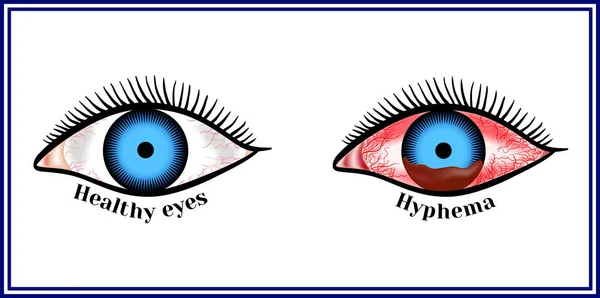 Hifema - hemorragia en la cámara anterior del ojo . Gráficos Vectoriales
