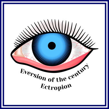 Ectropion. Bir yüzyılın eversiyon. 