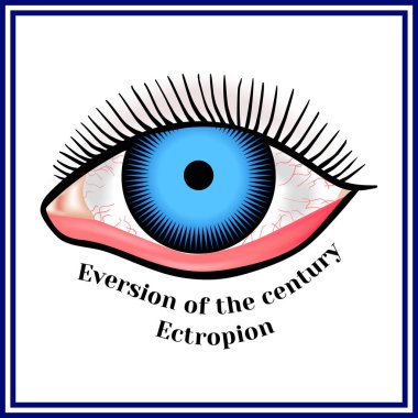 Ectropion. Eversion of a century.  clipart