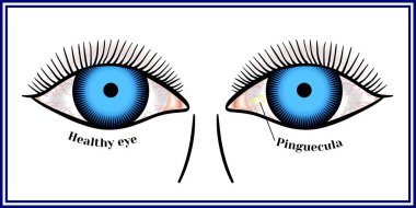 Pinguecula. Benign neoplasm of yellow color. clipart