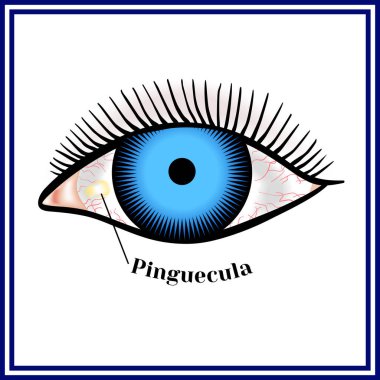 Pinguecula. Benign neoplasm of yellow color. clipart