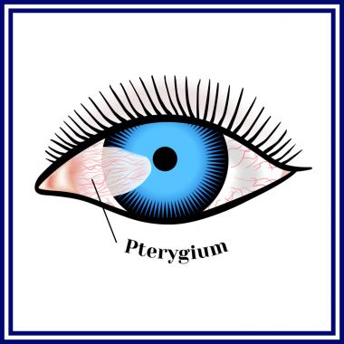 Pterygium. Spreading of the conjunctiva of the eye on the cornea clipart