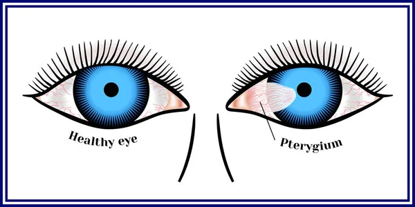 Pterygium. Menyebarkan conjunctiva mata pada kornea - Stok Vektor