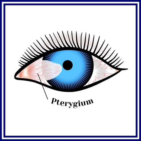 Ptérygium. Ecartement de la conjonctive oculaire sur la cornée Vecteurs De Stock Libres De Droits