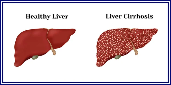Hígado sano y cirrosis . — Vector de stock