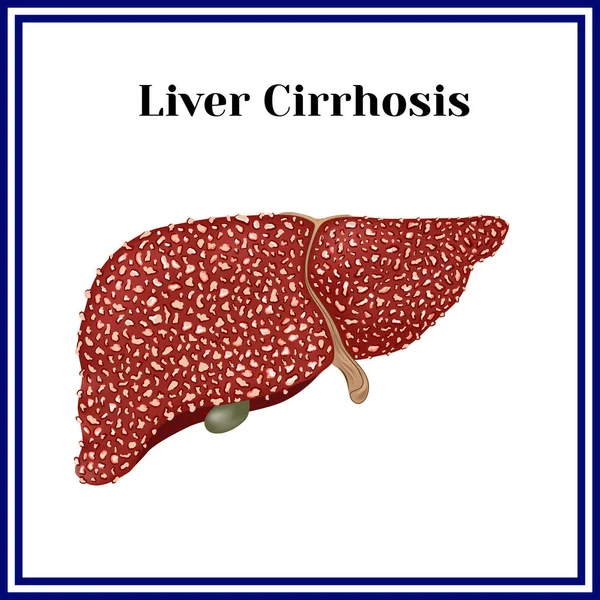 Cirrose. Schending van de structuur van de lever. — Stockvector