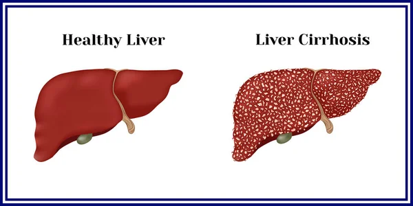 Hígado sano y cirrosis . Ilustraciones De Stock Sin Royalties Gratis