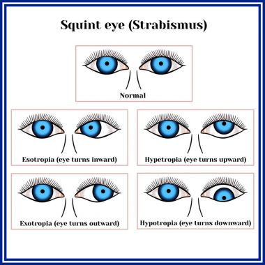 Squint eye (Strabismus) clipart