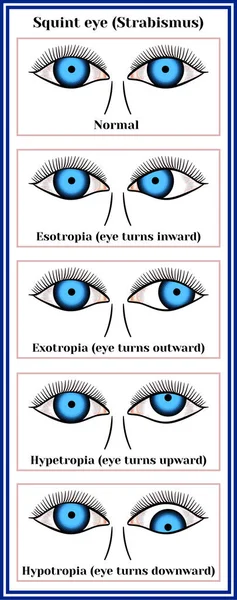 Zelený oční (Strabismus) — Stockový vektor