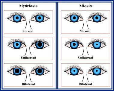 Mydriasis ve miosis.
