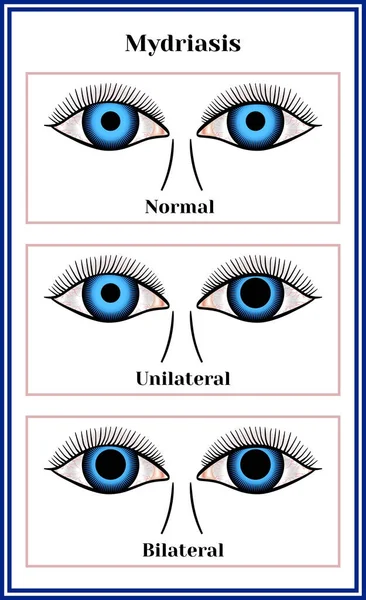 Mydriasis — 스톡 벡터