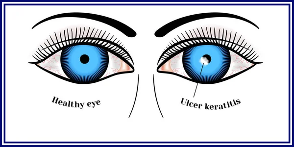 Queratitis Ulcerativa Proceso Inflamatorio Ulcerativo Destructivo Córnea Vector De Stock