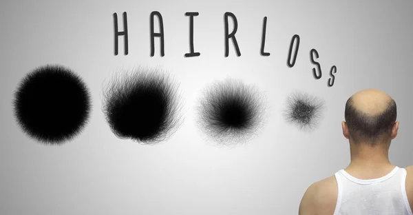 脱发的概念。显示 hairloss 进度的设置. — 图库照片