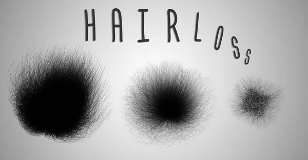 Set di acconciature che mostrano il progresso della perdita di capelli . — Foto Stock