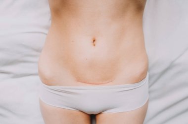 Closeup of woman belly with a scar from a cesarean section clipart