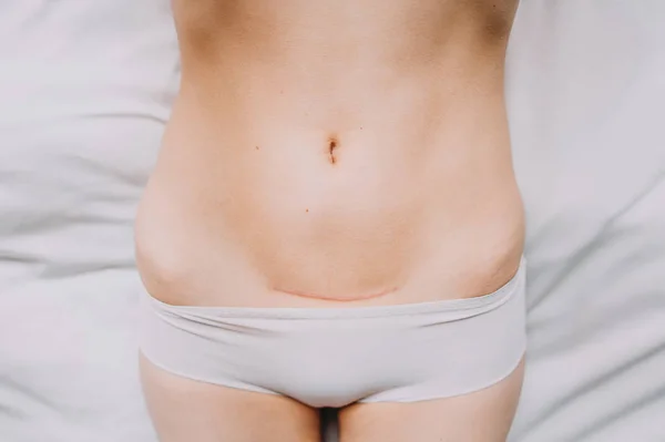 Крупним планом жіночий живіт з шрамом з кесаревого розтину — стокове фото