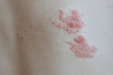 Symptoms of shingles on his back clipart