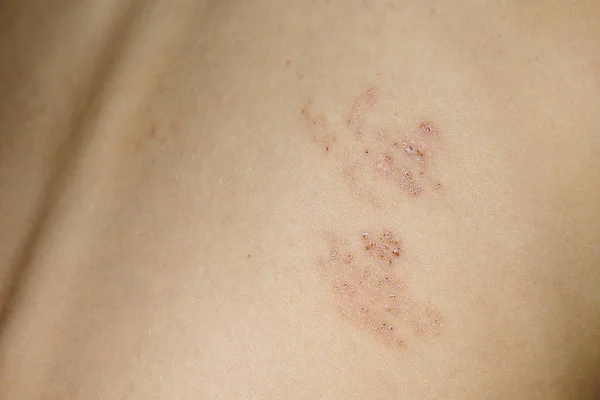 Objawy półpaśca na plecach — Zdjęcie stockowe
