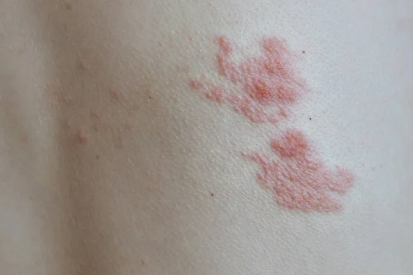 Objawy półpaśca na plecach — Zdjęcie stockowe