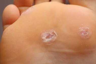 Siğiller gelişimi ve tasfiye aşamasında kendi .