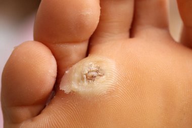 Siğiller bir genç kıza bacak 