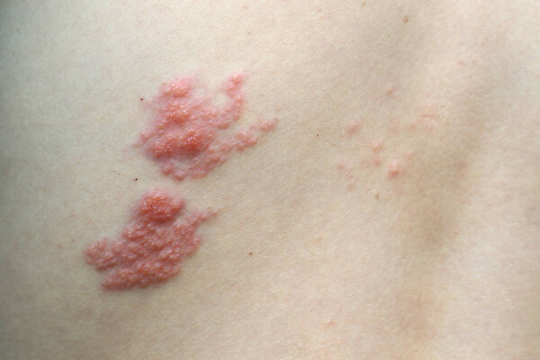 The back of a girl suffering from infectious shingles disease