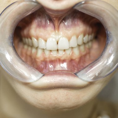 Diş macunu, resepsiyondaki dişçi kadının dişlerini beyazlatmadan önce mükemmel bir gülümseme için dişlerini beyazlatır. Diş randevusu.