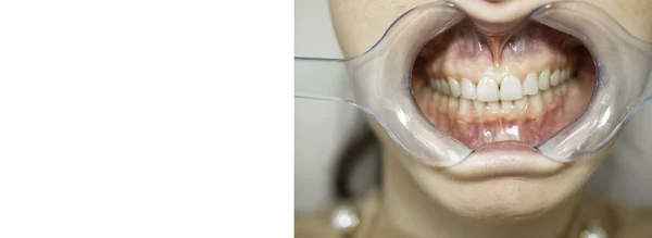 歯のホワイトニング前に歯の口のスプレッダーレセプション歯科医で歯の女性は完璧な笑顔を得るために あなたの歯を白くする 歯科任命 — ストック写真