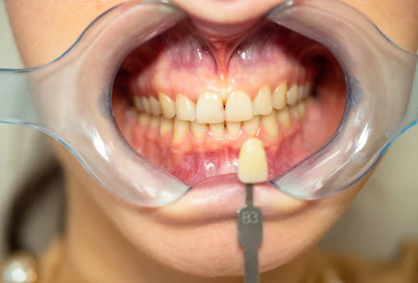 Rozwieracz Zębów Przed Wybielaniem Zębów Kobieta Recepcji Dentysty Aby Uzyskać — Zdjęcie stockowe