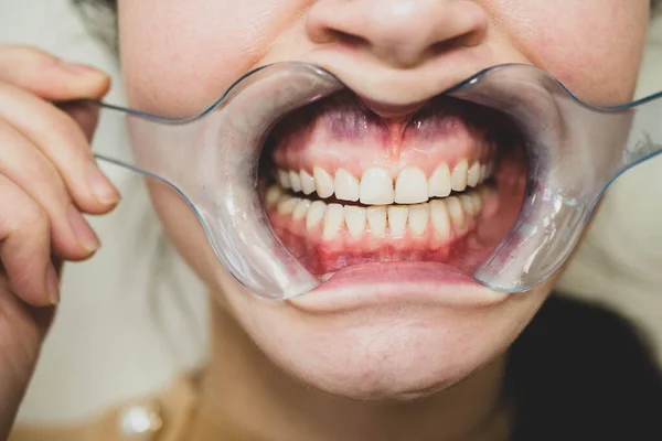 Zahnmundspreizer Vor Zahnaufhellung Zahnärztin Der Rezeption Perfektes Lächeln Bekommen Machen — Stockfoto