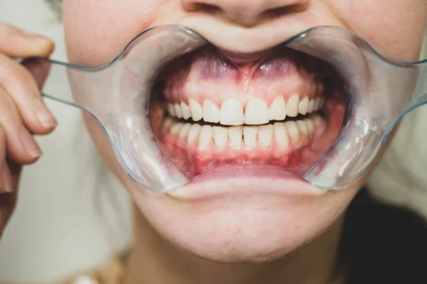 歯のホワイトニング前に歯の口のスプレッダーレセプション歯科医で歯の女性は完璧な笑顔を得るために あなたの歯を白くする 歯科任命 — ストック写真