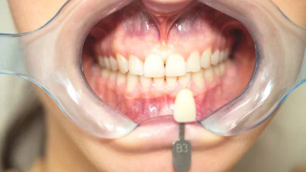 Épandeur Bouche Dentaire Avant Blanchiment Des Dents Dents Femme Chez — Photo